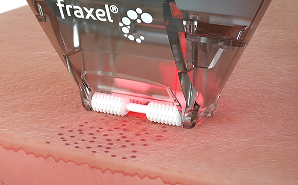 Fraxel