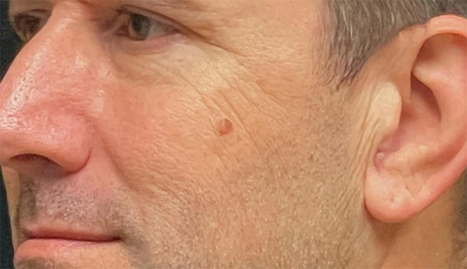 Before image of wrinkles and fine lines treatment