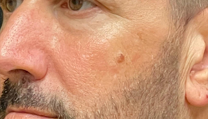 After image of wrinkles and fine lines treatment